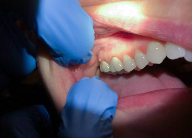 Best Emergency Dentist for Knocked-Out Tooth in Morenci, MI